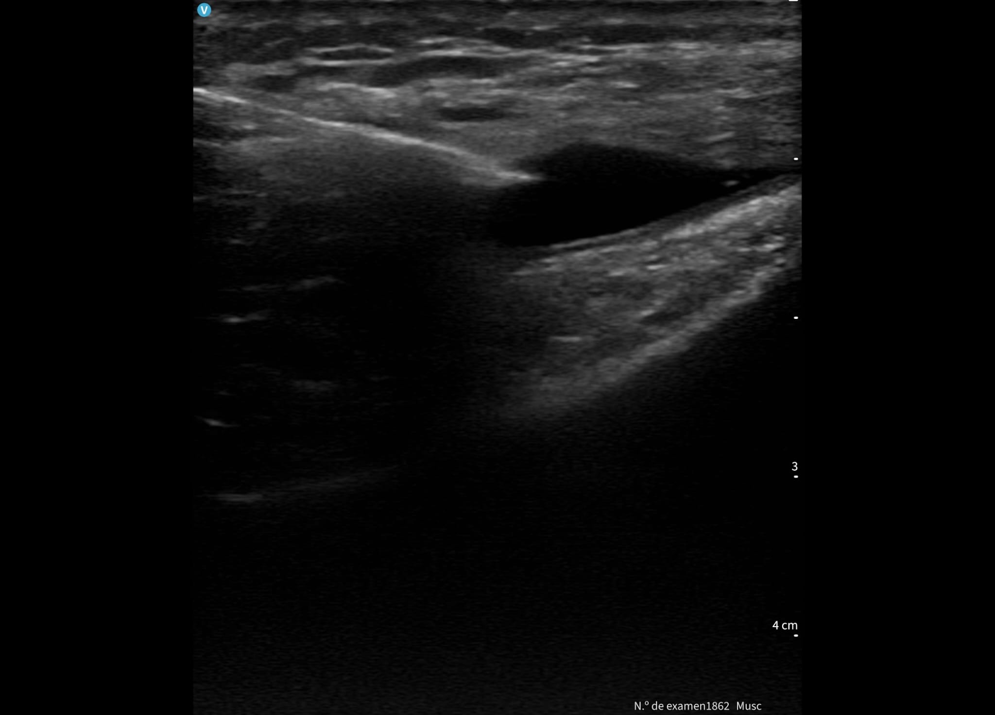Durante la aspiración